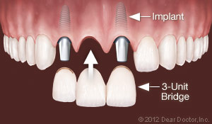 Dental Implants Replace Multiple Teeth.